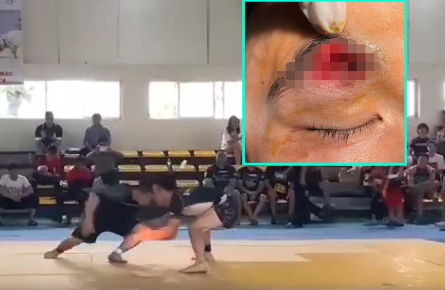Tai nạn húc đầu tại giải Jujitsu toàn quốc, võ sĩ phải khâu 30 mũi