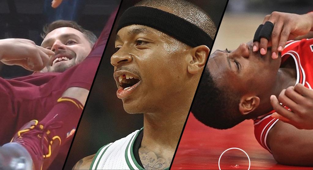 Những pha va chạm khiến sao NBA... mất răng