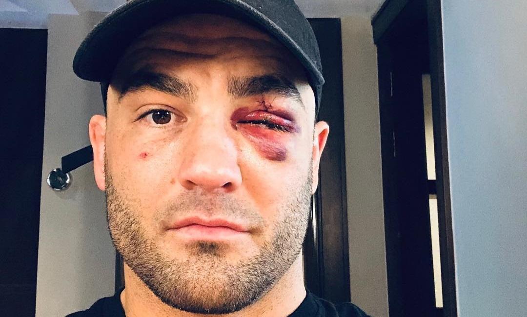 Eddie Alvarez suýt bị 'xé' mất mí mắt tại A New Era